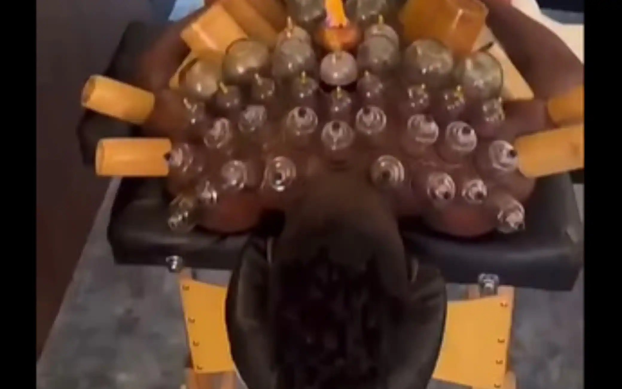 Onana si dà alla coppettazione: il VIDEO su Instagram è impressionante